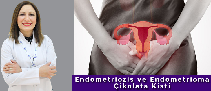 Endometriozis ve Endometrioma çikolata kisti 